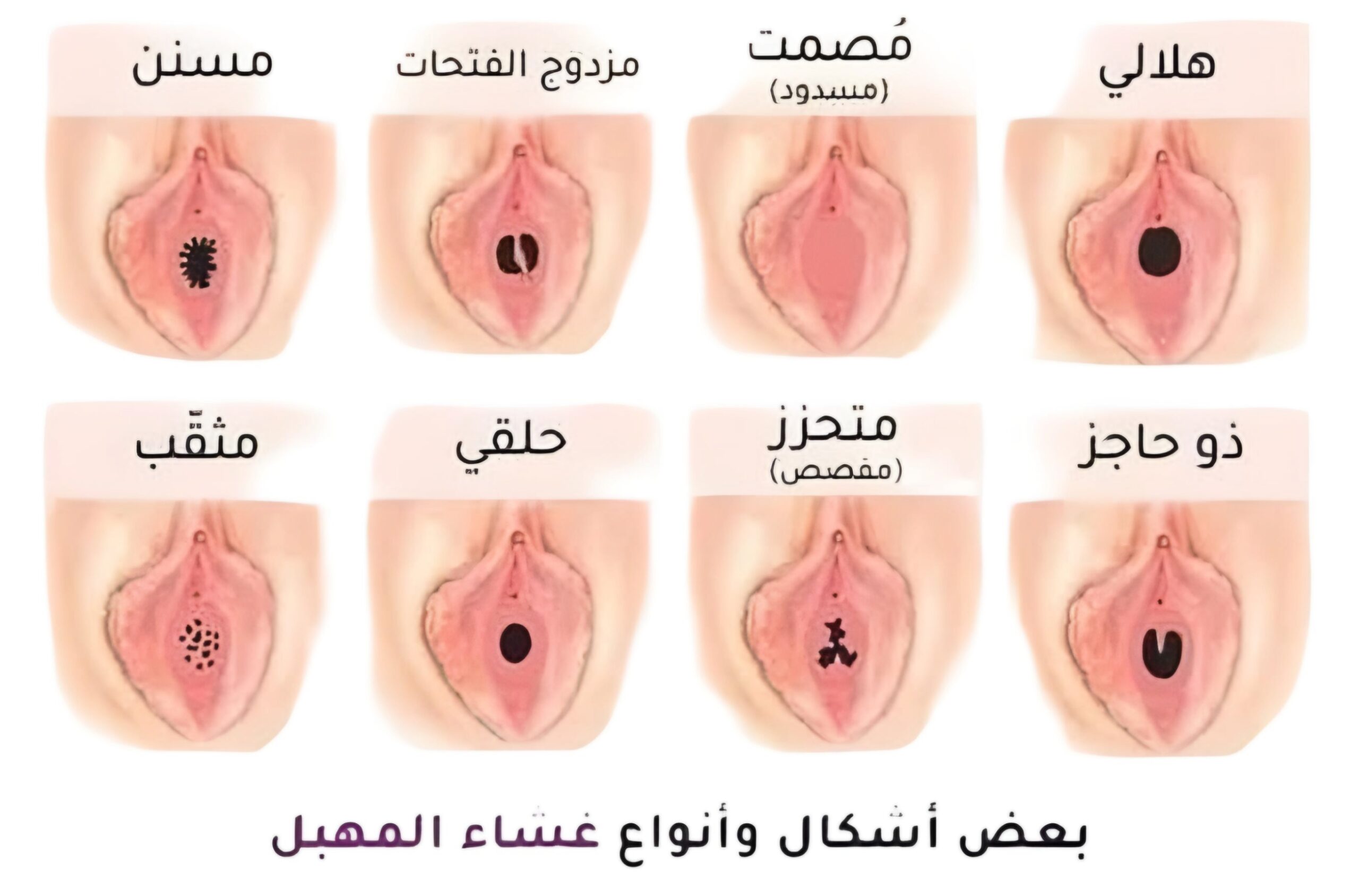 أنواع غشاء البكارة 